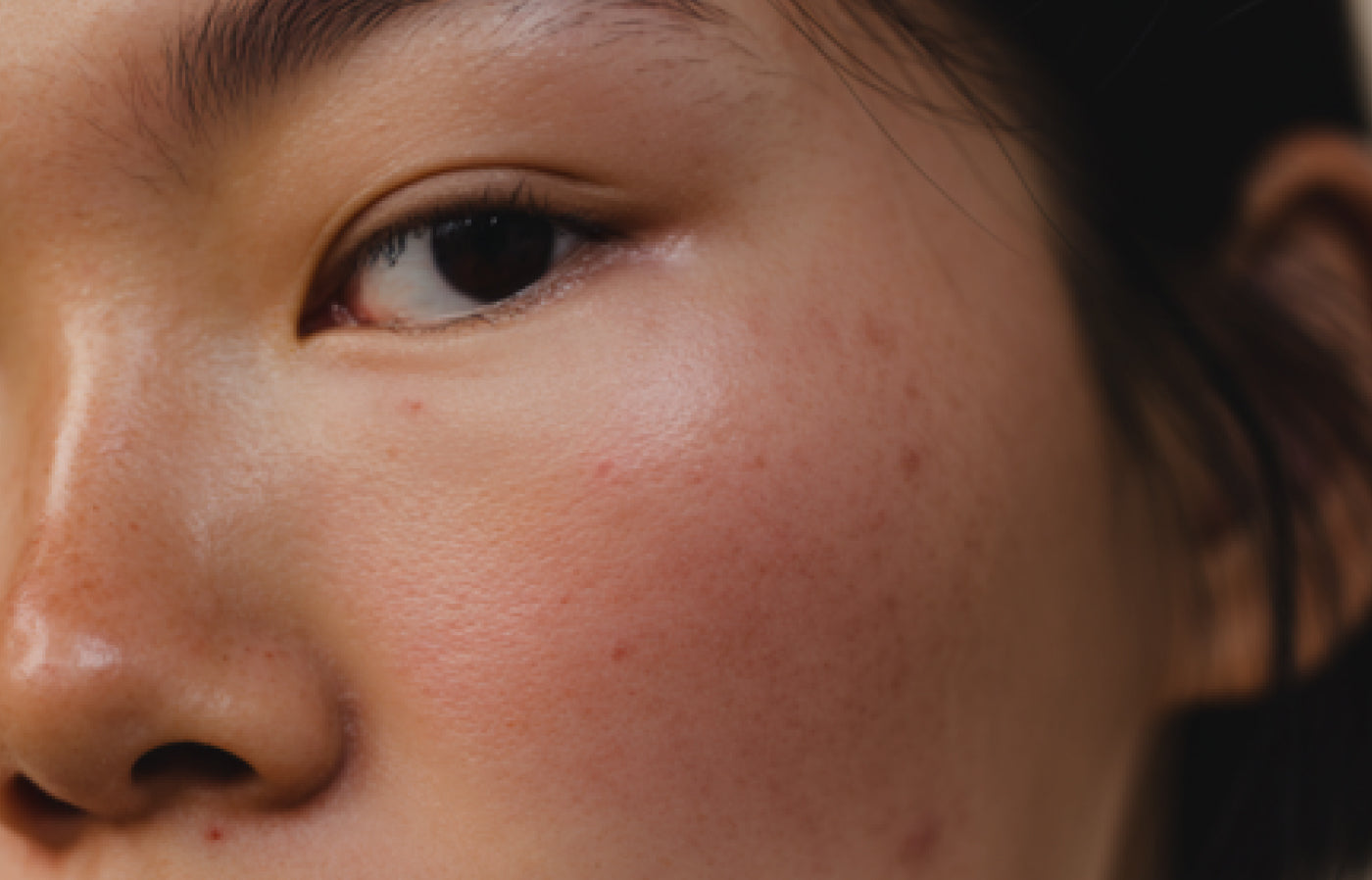 Post-summer skin: How to reduce blemishes and rebalance excess sebum